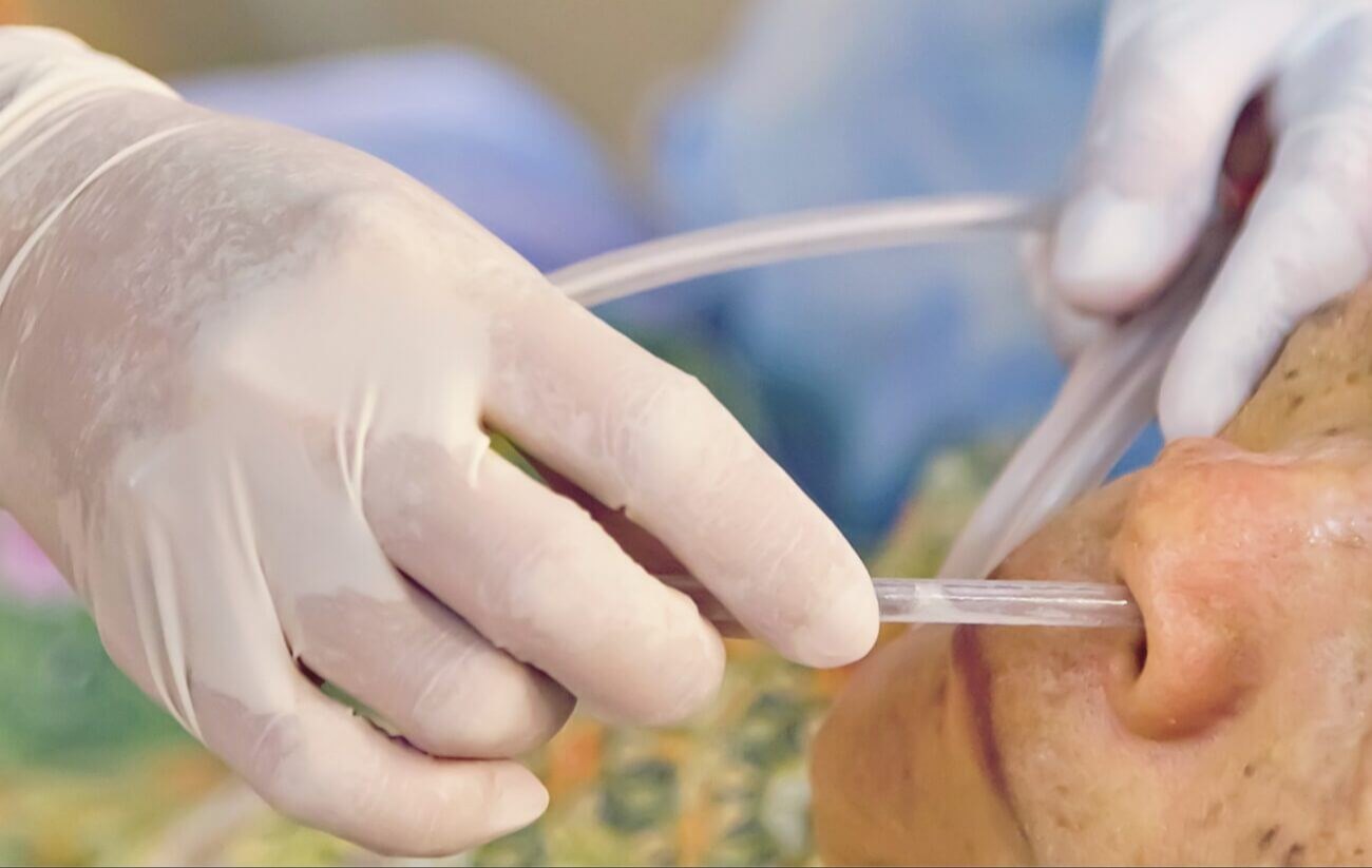 Ryle's Tube Insertion